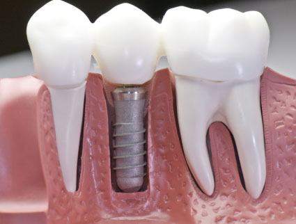Visual of a dental implant in cross section