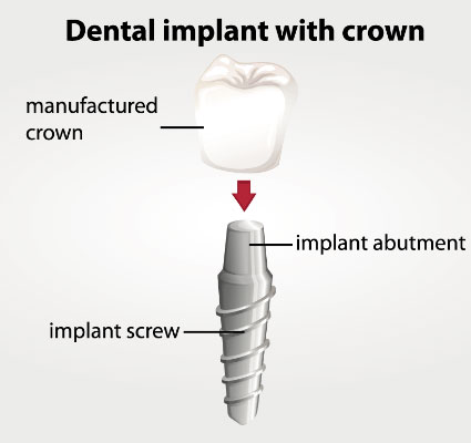 Illustration of a dental implant screw, implant abutment and crown