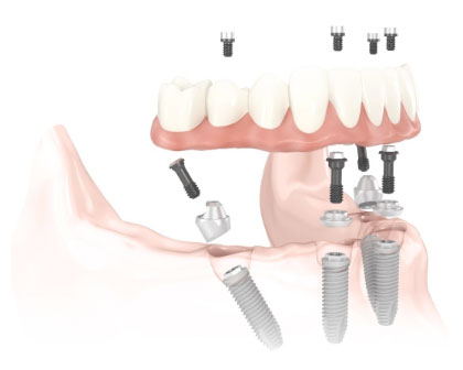 The All-on-Four is one full arch of teeth for dental implants