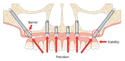 Zygomatic implants - what are they and what do they cost