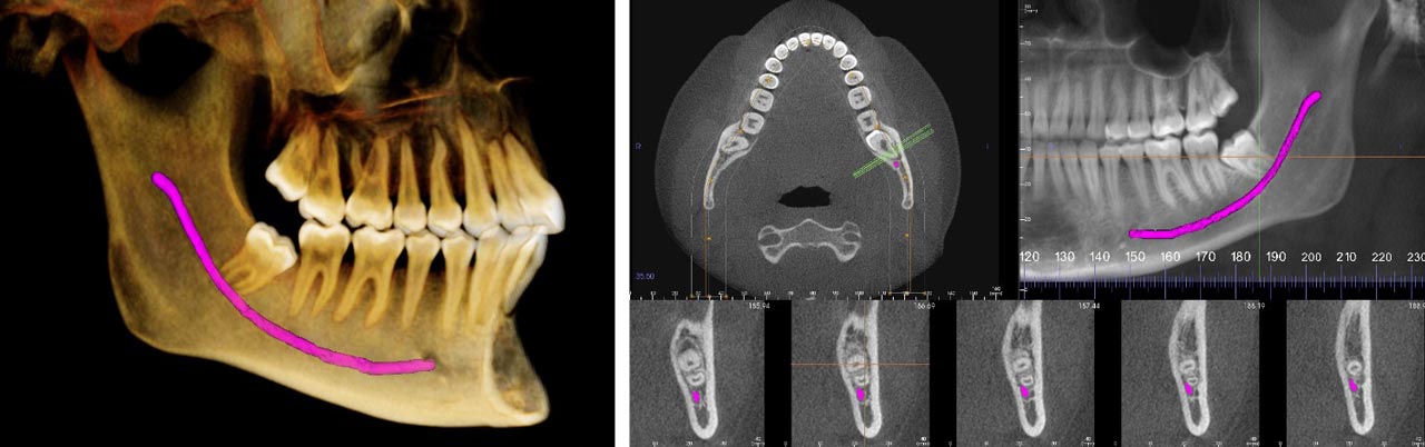 3D low-dose imaging for oral surgery in Allentown, Bethlehem and Lehighton PA