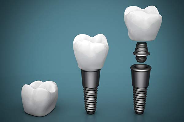 Repair a Broken Tooth in Allentown, PA