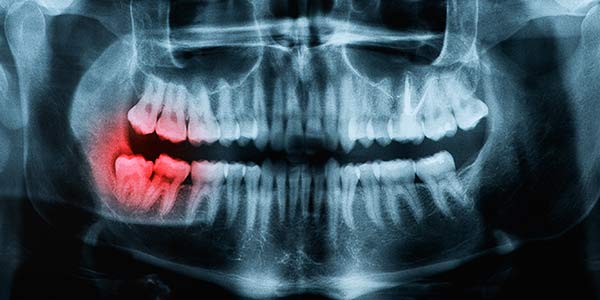 Wisdom tooth xray